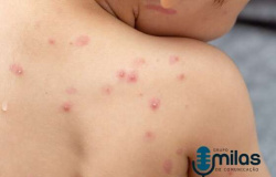 Cuiabá registra mais três casos positivos de Monkeypox